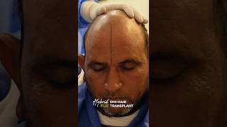 Today's procedure at Hair Club: FUE Hair Transplant with DHI technology.