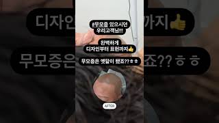 무모증은 옛말이 되어버렸죠? #탈모커버