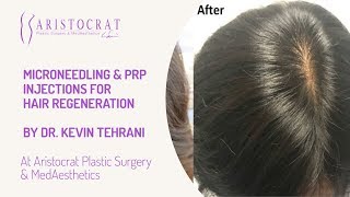 Microneedling PRP Injections for Hair Regeneration Long Island, New York by Dr. Kevin Tehrani