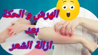 الهرش والحكة فى الأماكن الحساسة  بعد ازالة الشعر 💥كريم طبى فعال وطريقة  استخدامه الصحيحه