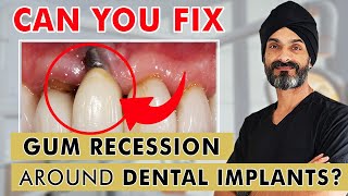 Can You Fix Recession (Gum Loss) Around Dental Implants