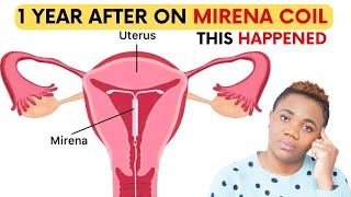 What To Expect On Mirena Coil Contraception | Update 1 Year After