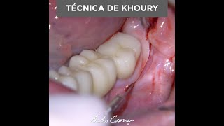 Técninca de khoury #shorts