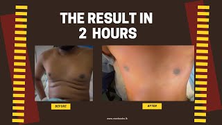 Psuedo-gynecomastia: Incredible results after liposuction in Kandy Manboobs Center. 0777 567 566