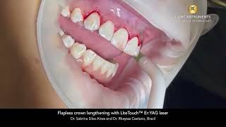 Flapless crown lengthening with LiteTouch™ Er:YAG laser