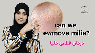 can we ewmove milia? | درمان قطعی میلیا