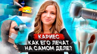 Лечение кариеса этапы: как лечат кариес в стоматологии? Процесс лечения кариеса