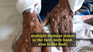 Neurofibromatosis.