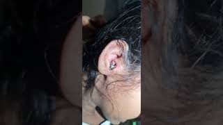 ear wax removal