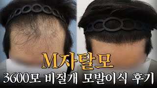 [Mobien TV] 30대 남성 M자 모발이식 비절개 3600모 7개월 경과 #광주탈모치료 #전남모발이식