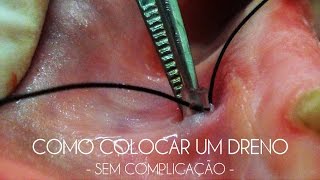 Como Colocar um Dreno Sem Complicação