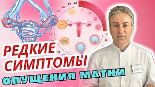 РЕДКИЕ СИМПТОМЫ Опущения Матки | Варикоз, Мочеиспускание и Выделения у женщин | Гинеколог Ермолаев