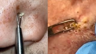 Top 10 Cysts, Blackhead Clusters, Comedones, Nose Pimples, Chin Zits and Big Pustules