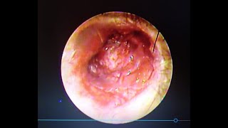 Two handed endoscopic tragal cartilage tympanoplasty with dr.khan's endohold- Dr.Shreekantha Acharya