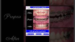 ارتودنسی و جراحی اپن بایت | دکتر احسان ابویی مهریزی