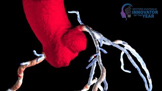 3D Models of Diseased Arteries