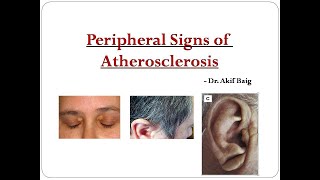 Peripheral signs of atherosclerosis : Dr. Akif Baig