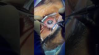 Surgeon Undergoing Smile Eye Surgery!! #eye #eyecare #eyehospital #smileeyesurgery #smilesurgery