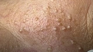 Satisfying blackhead relaxing with music