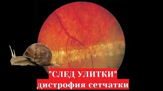 Дистрофия сетчатки по типу след улитки - нужно ли делать лазерную коагуляцию и рожать самой?