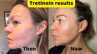 Dermatica tretinoin 6-month results update - plus how to manage sun sensitivity