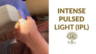 Intense Pulsed Light (IPL) For Skin Improvement On Hands