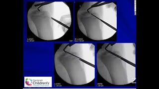 Paediatric ACL tears and Tibial Spine Fractures