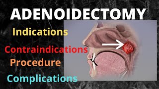 065.Adenoidectomy  #adenotonsillectomy #surgeryeducation