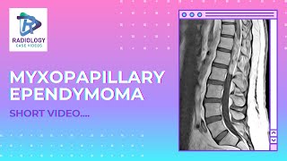 Myxopapillary Ependymoma   #Umamaheshwar Reddy. V