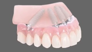 Clip of All-On-4 Dental Implants