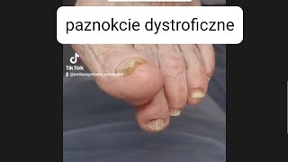 paznokcie dystroficzne - zabieg podologiczny @podopogotowie #podologia #toenails