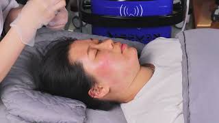 Fractional M8 Microneedle RF Machine Treatment Training Video