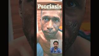 Psoriasis patient information @DrArifMDDermatologist #psoriasis #shorts #skin