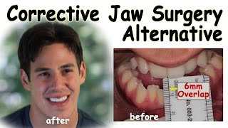 Corrective Jaw Surgery Alternative - Underbite Correction without Surgery