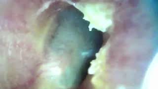 onset of fungal ear infection.  Начало гриькового отита