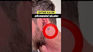 İŞİTME KAYBI DÖVMESİNİ SİLMESİ GEREKİYOR! #hearingloss #chiropractic