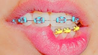 จัดฟัน ดัดฟัน (BRACES)