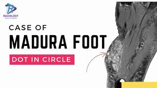 Dot in circle sign Madura foot #MaduraFoot#DotInCircleSign#Mycetoma#Radiology#SoftTissueInfection