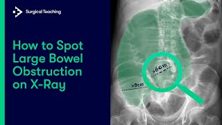 Diagnosing Large Bowel Obstruction on X-Ray