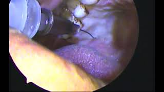 Pterygopalatine (GPN canal injection)  bock for fess under LA-Dr.Shreekantha Acharya