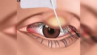 Asmr eye infection removal..