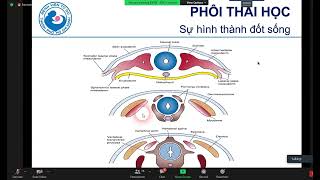 Siêu âm chẻ đôi Đốt sống (thể kín và thể hở) - BS. La Hồng Châu