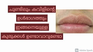 വായയിൽ ഇതേപോലുള്ള മാറ്റങ്ങൾ ശ്രദ്ധിക്കാറുണ്ടോ?  Fordyces Granule Explained in Malayalam | Dr.Anagha