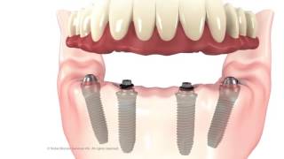 Animation Of How All On 4 Dental Implants Work