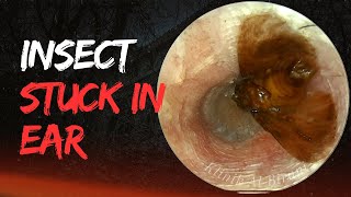 Insect Stuck In Ear For 2 Days🤯