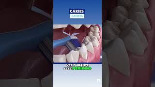 ¿Estás EMBARAZADA? ¡Cuidado con la CARIES DENTAL!