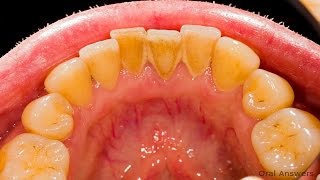 HOW TO REMOVE PLAQUE WITHOUT GOING TO THE DENTIST; Amazing