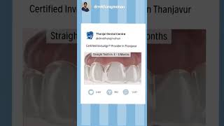 Teeth gap Closing without Metal Wires #clearaligners #invisalign