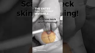 Scarless Neck Skin Tightening with AccuTite