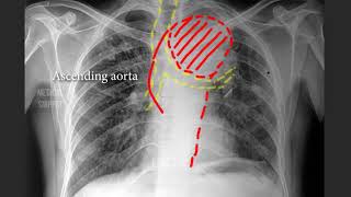 Ortner's syndrome | Aortic Arch Aneurysm | Diagnosis by CXR